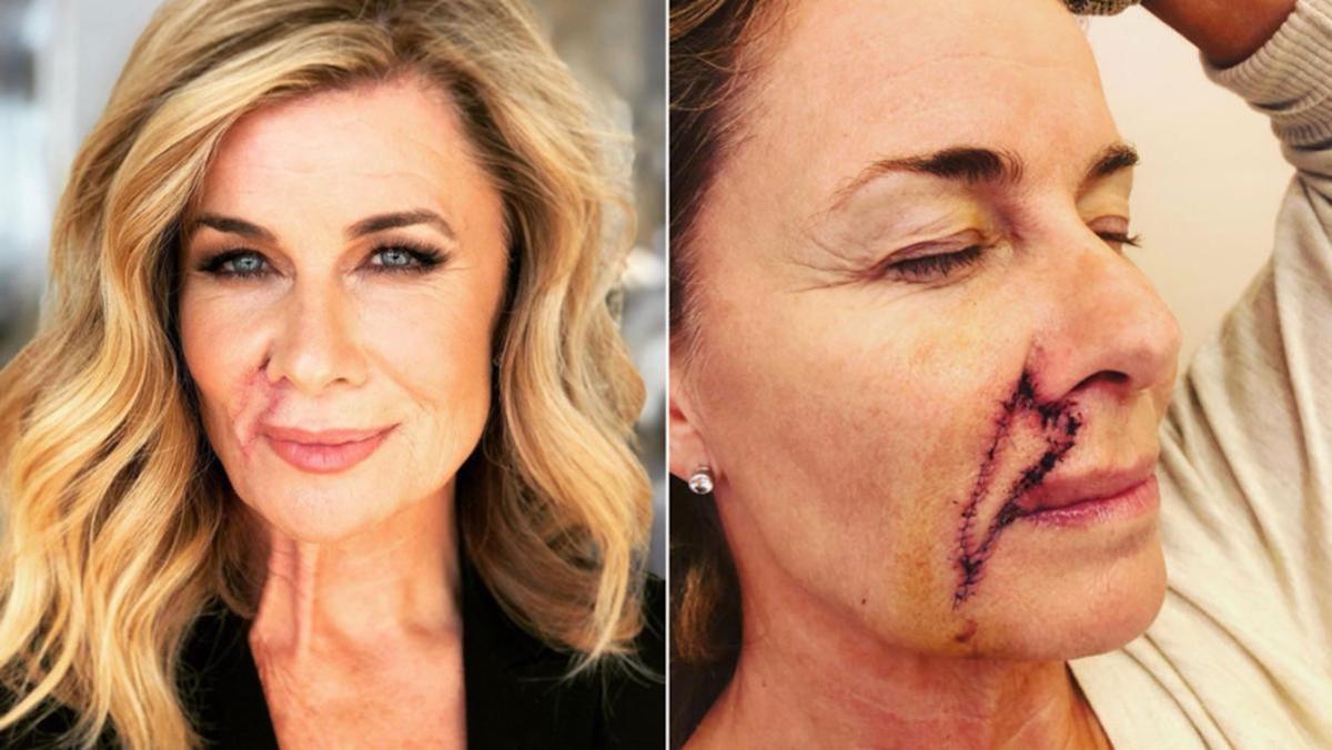 Deborah Hutton's skin cancer scar